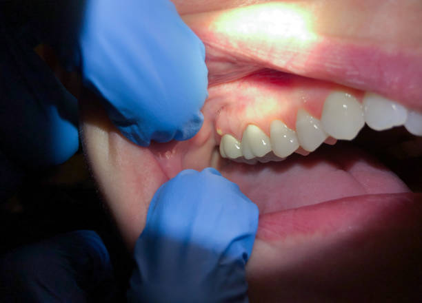 Best Dental Abscess Treatment in Rosanky, TX